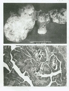 بيماريهاي تخمدان و لوله هاي رحمي چیست؟(1)